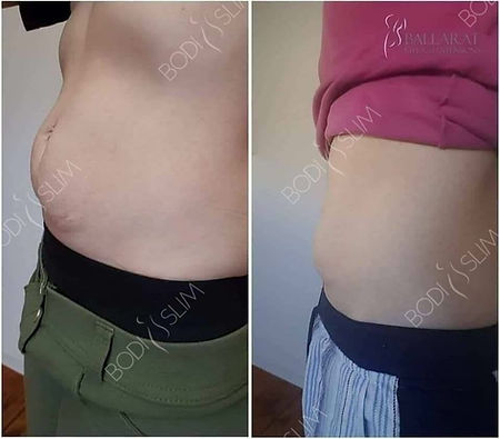 fat freezing before and after Bodi Slim courses & training