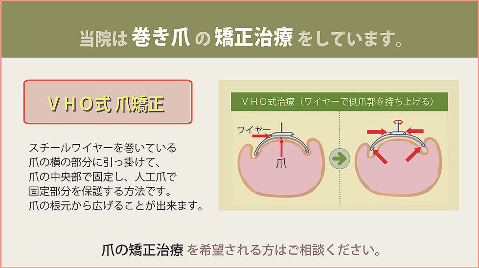 巻き爪の矯正治療