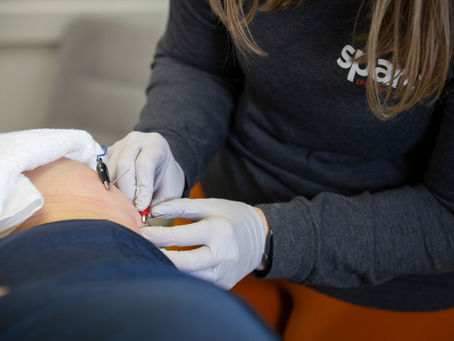 Dry Needling vs Acupuncture
