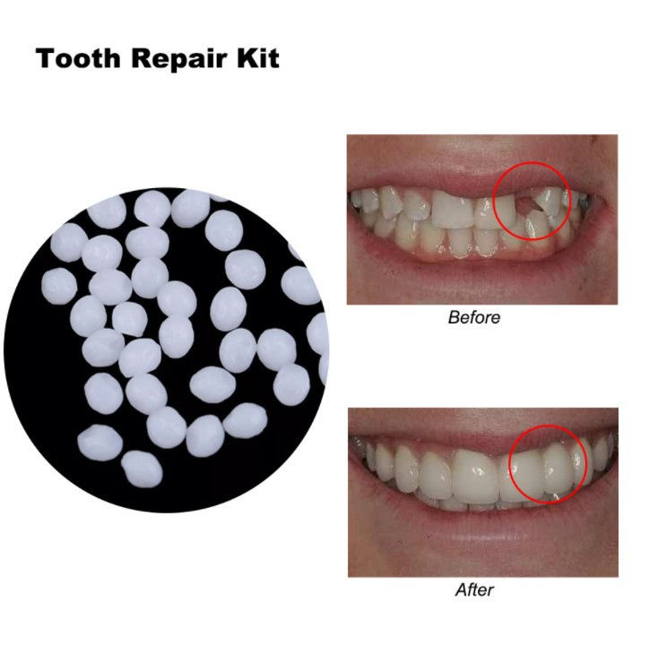 Thumbnail: Temporary Tooth Gap Repair Kit