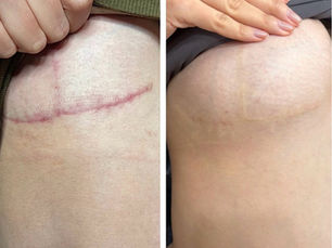 Breast lift scar camoflauge