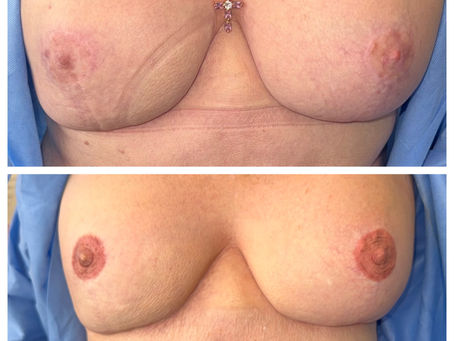 3D hyper realism Areola and nipple tattoo..