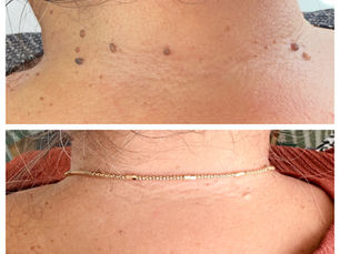 Skin tag removal