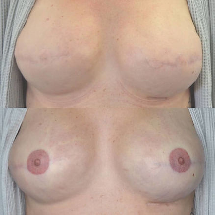 3D Nipple & Areola Tattoo - before & after