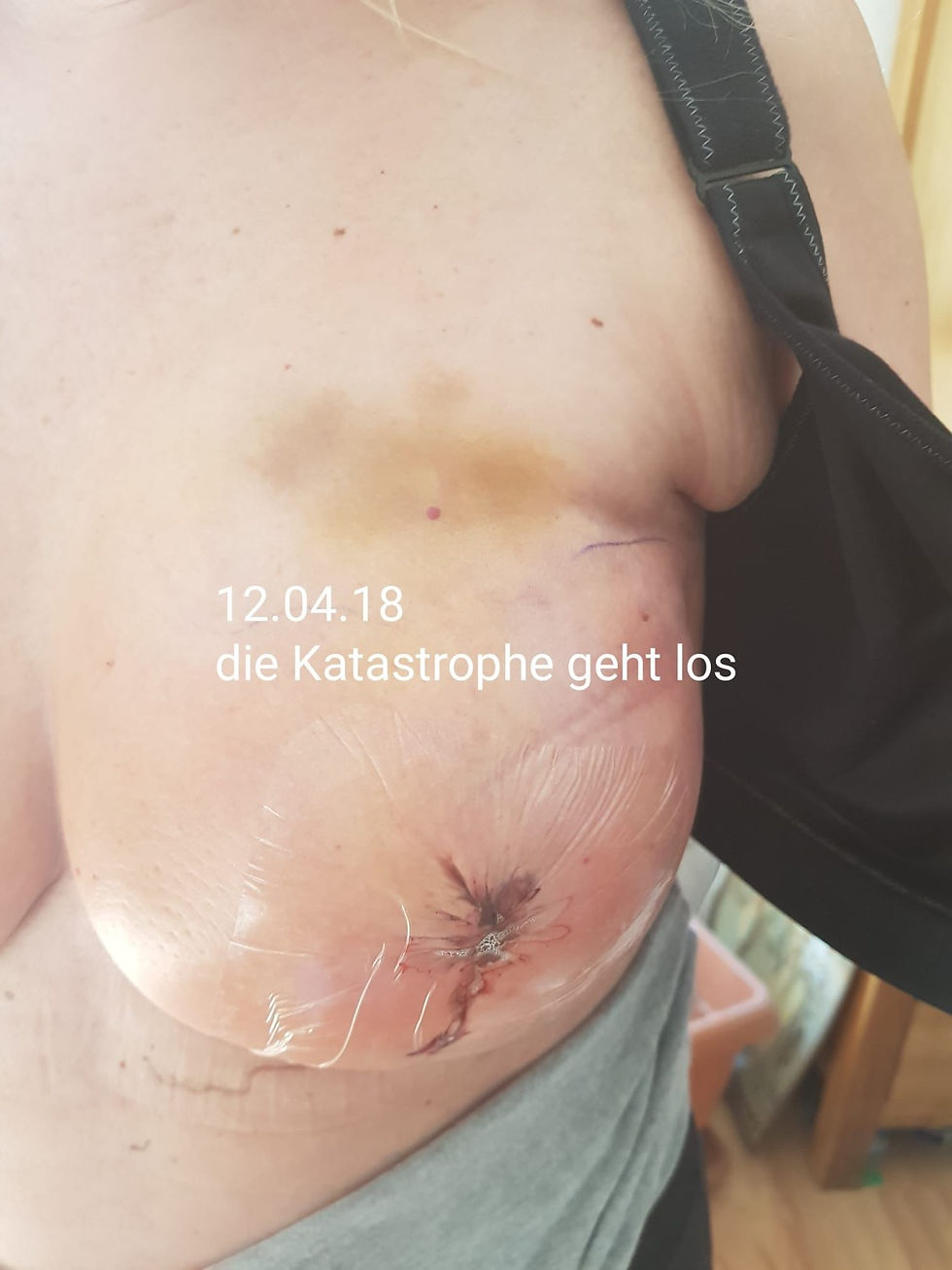 Brustkrebs