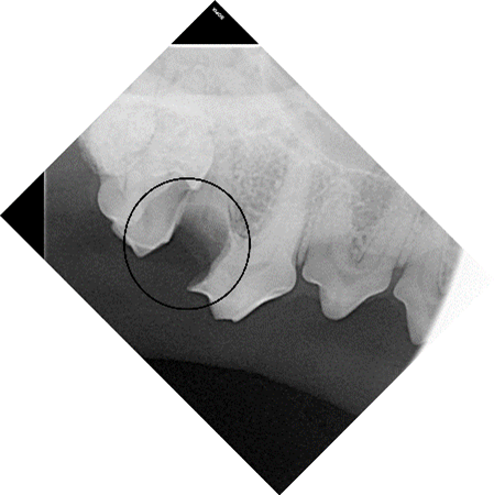 Dental X-ray of Fractured Crown of a Tooth