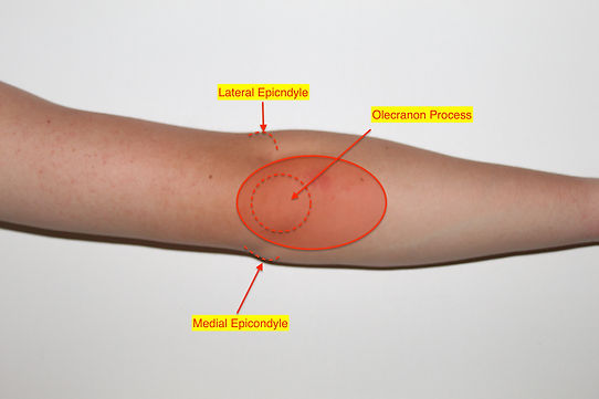 Olecranon fracture