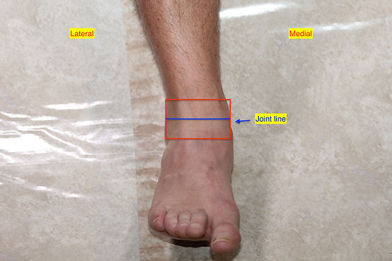 Ankle OA