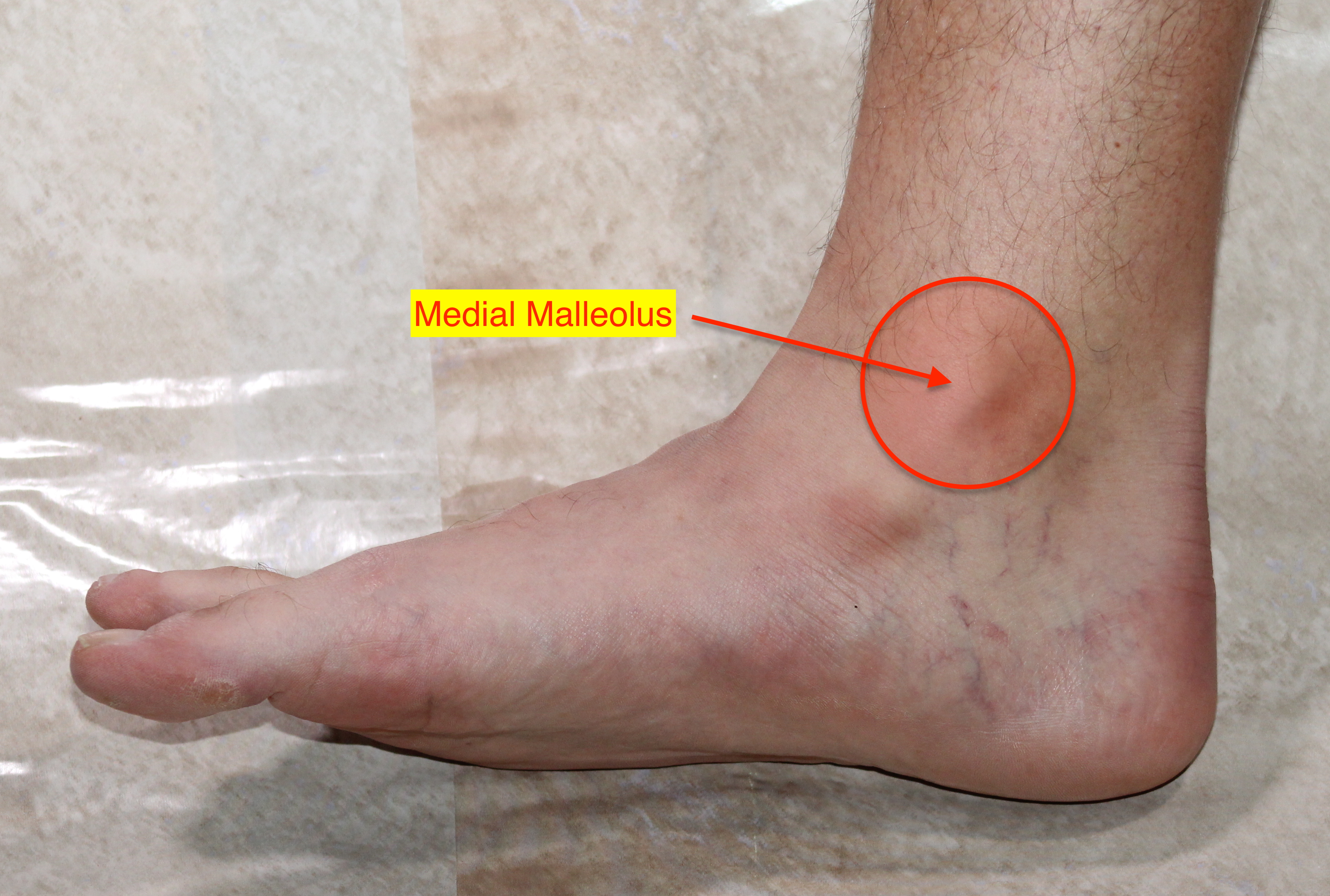 pain on outside of foot pain on outside of foot