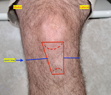 Patellar tendonitis