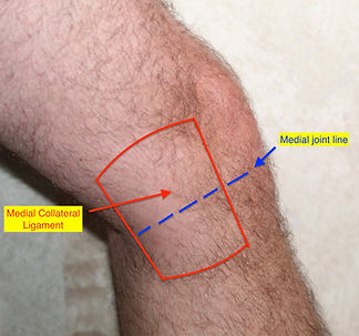 MCL sprain