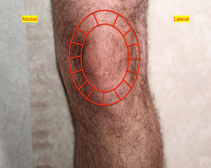 Anterior PF Syndrome