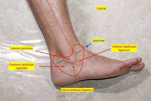 Lateral Ankle Sprain