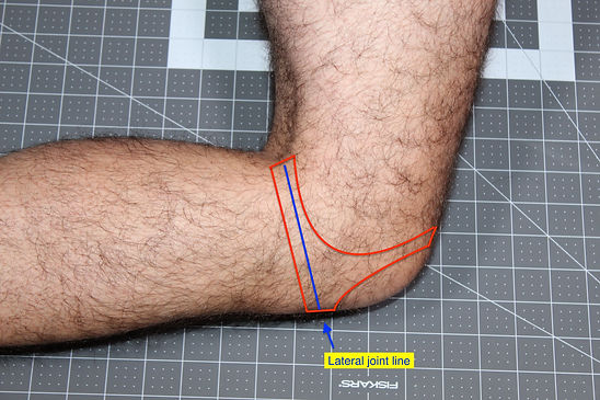 Lateral OCD