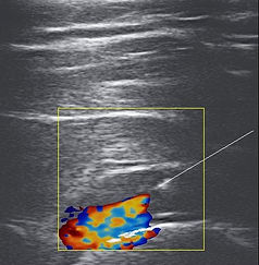 어깨초음파주사
