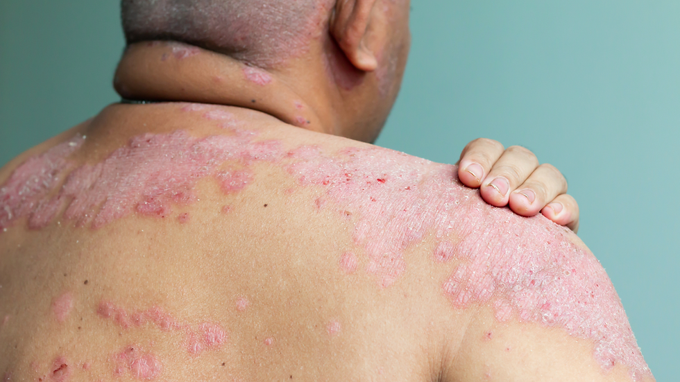 PSORIASIS - PART 1