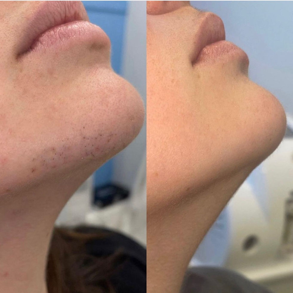 Chin before and after. 6 sessions