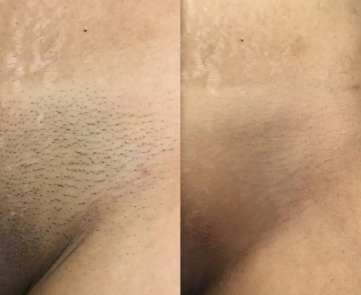 Hollywood before and after - 6 sessions