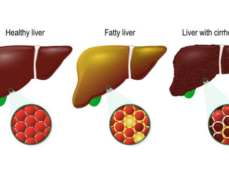 หยุด “ไขมันพอกตับ” ก่อนตับจะพา “ดับ” ด้วยมะเร็ง
