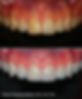 teeth-whitening-in-boston-or-dental-veneers-dental-esthetics-boston.png