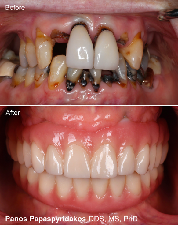 before-and-after-all-on-4-dental-implants-dental-esthetics-boston