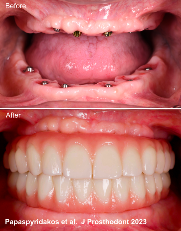 all-on-4-dental-implants-dental-esthetics-boston