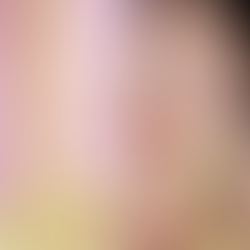 How To Treat Sunburn