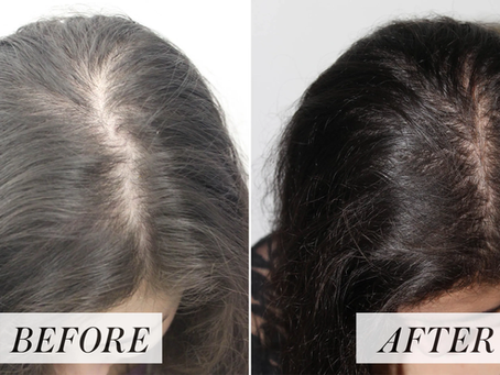 What do You need to Know About PRP Hair Loss Treatment?