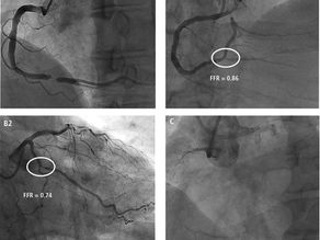 מה עושים במקרה של חסימה כרונית מלאה (CTO) ?