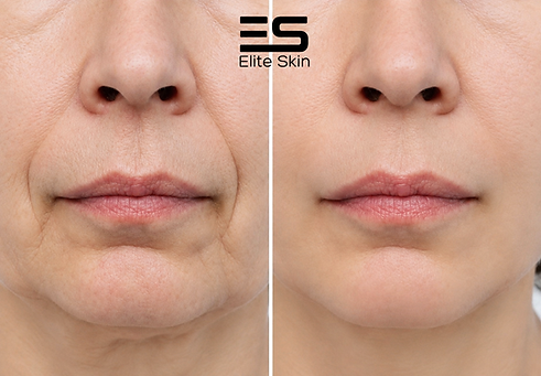 SCULPTRA.png