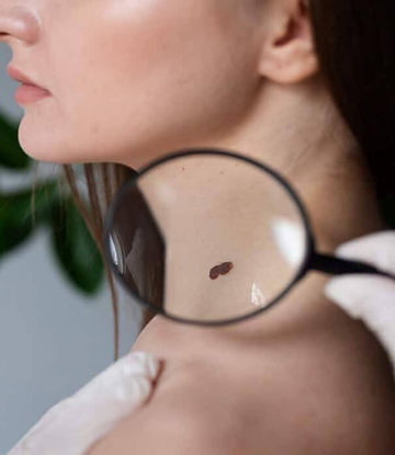 Mole_ Wart_ Milia_ Skin Tag Removal _edited.jpg