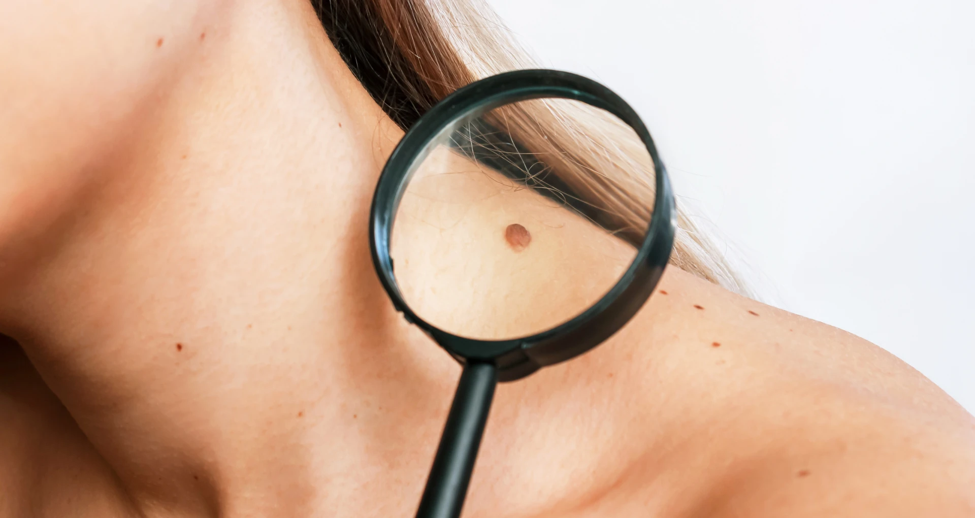 Mole and skin tag removal treatment at EliteSkin London clinic