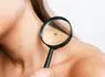 Mole and skin tag removal treatment at EliteSkin London clinic