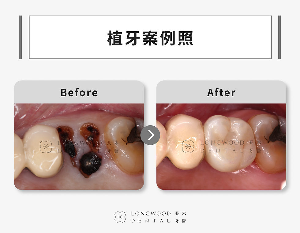 長木牙醫植牙案例照
