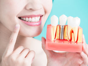 Implantes dentários: tudo o que precisa de saber