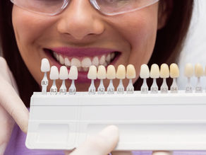 Mito ou verdade: facetas de resina estragam os dentes?