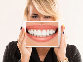 6 principais mitos sobre faceta dentária