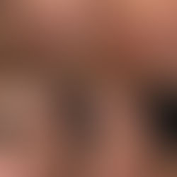 Breakout Saat Ramadan? Kenali Penyebab & Pendekatan Regeneratif untuk Menjaga Kesehatan Kulit Saat Puasa