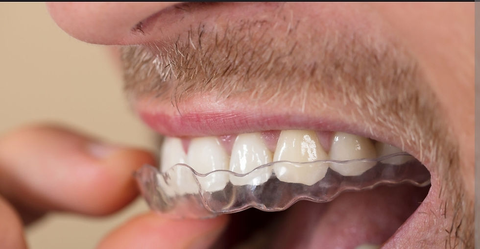 Gouttière de bruxisme