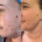 Microneedling B&A-3.webp