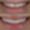 Porcelain Veneers New York - Dr. Tristan Lue, DDS