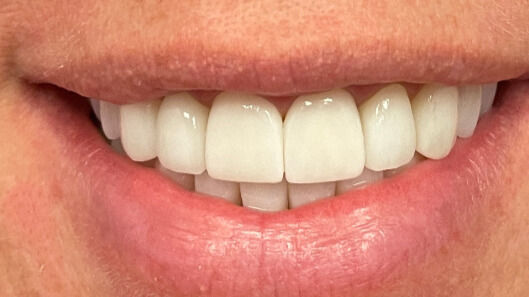 Before After Verity Smile Studio Before After Verity Smile Studio