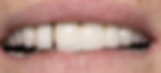 Before Smile Makeover Transformation - Shrub Oak Smiles - Dentist in Shrub Oak, New York