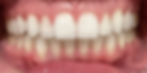After - Dental Smile Makeover - SMILELOUNGE