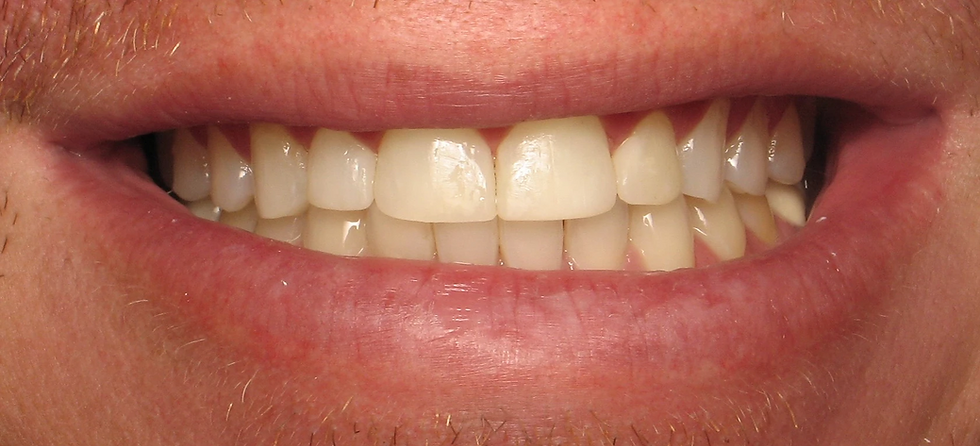 After - Dental Smile Makeover - Dental Arts of Chandler