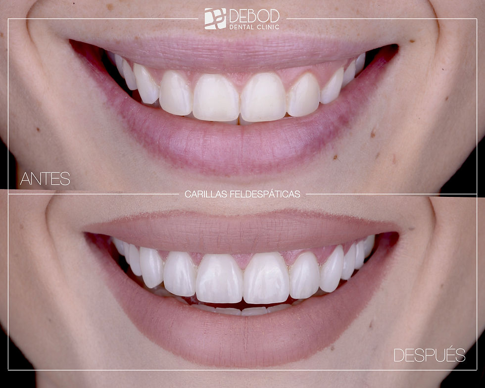 Diseño de Sonrisa en Argüelles, Madrid - Debod Dental Clinic