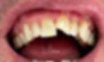 Before Smile Makeover Transformation - Shrub Oak Smiles - Dentist in Shrub Oak, New York