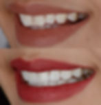 Porcelain Veneers New York - Dr. Tristan Lue, DDS
