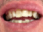 After Smile Makeover Transformation - Shrub Oak Smiles - Dentist in Shrub Oak, New York