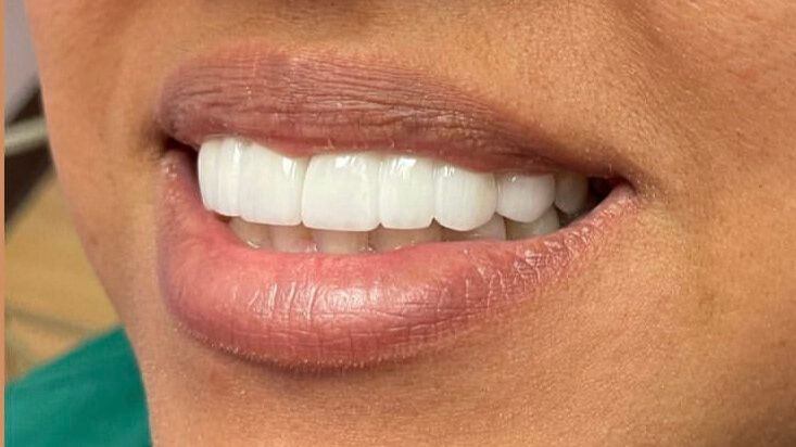 Antes Y Despu s Verity Smile Studio Antes Y Despu s Verity Smile Studio